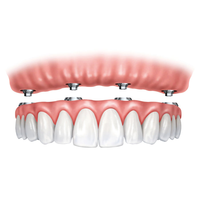 Overdentures - Dental Services